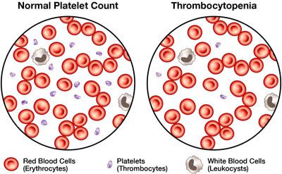 Illustration of blood cells showing normal platelet count and thrombocytopenia