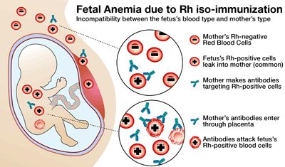 Illustration of fetal anemia due to Rh iso-immunization